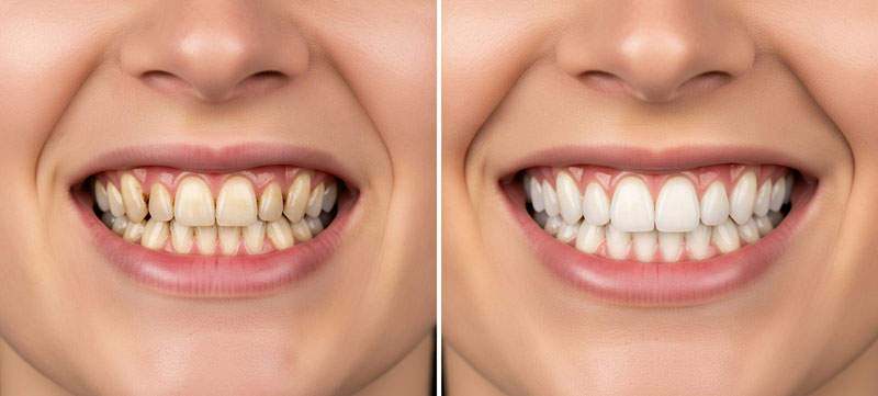Cosmetic Dentistry - Horizon City, TX & El Paso, TX - Horizon Dental