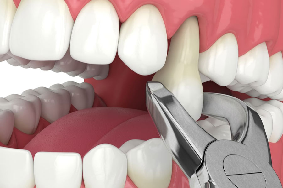 Painless Tooth Extraction and Wisdom Teeth in Horizon City and El Paso, TX