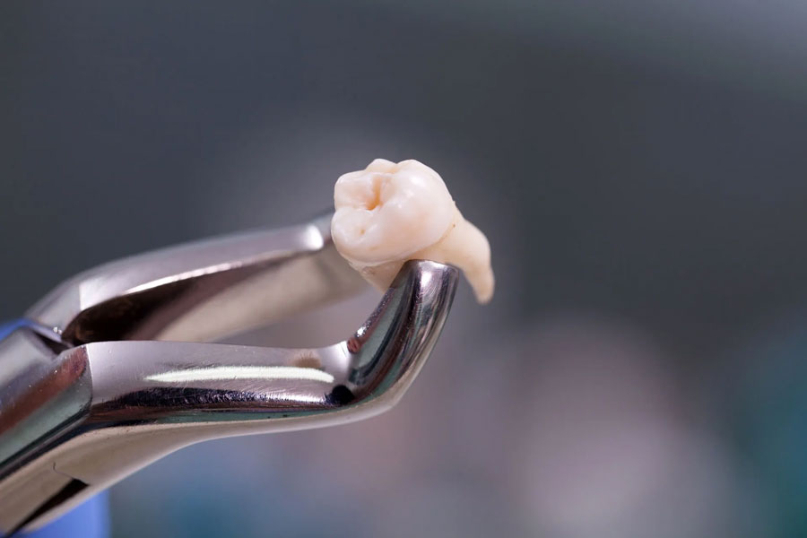 Painless Tooth Extraction and Wisdom Teeth in Horizon City and El Paso, TX