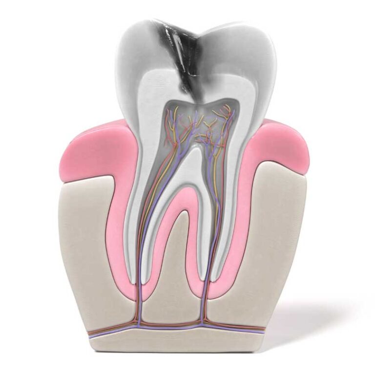 Saving Your Smile: Root Canals and Endoscopy Explained