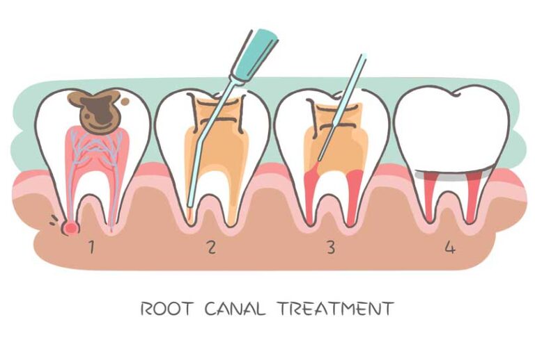 Root Canal Aftercare: Your Complete Recovery Guide