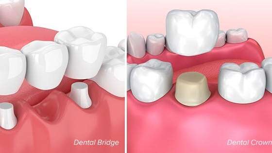 Dental Crown and Bridge Aftercare: A Patient’s Guide